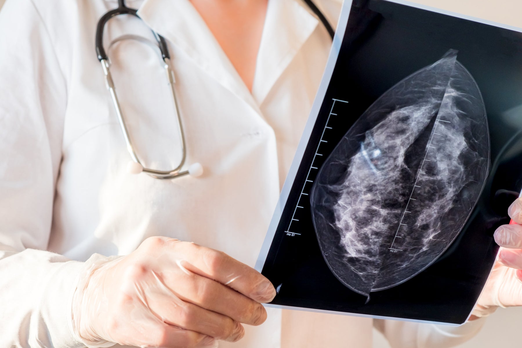 Why More Imaging Providers Are Purchasing Refurbished Mammography Systems