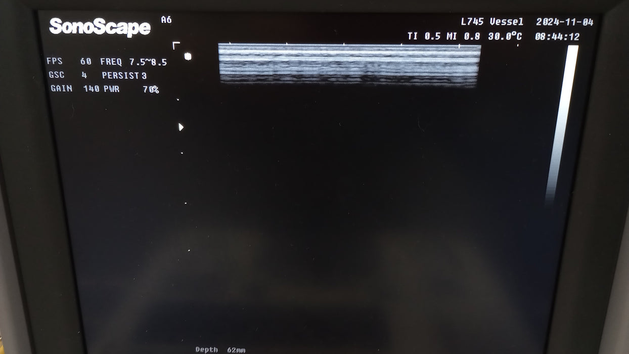 SonoScape Medical Corp SonoScape Medical Corp A6 Portable Doppler Ultrasound Ultrasound reLink Medical