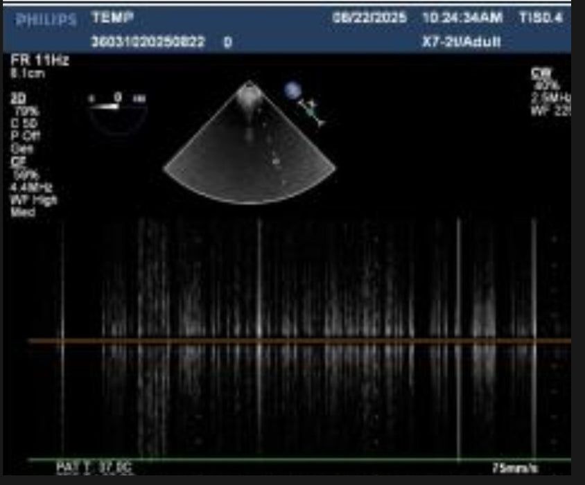 Philips X7-2t TEE Probe Transducer IE33 Version