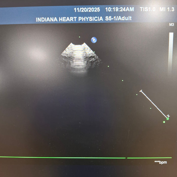 Philips S5-1 IE33/IU22 Sector Array Transducer