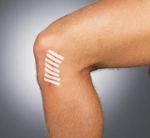 Gentell Gentell TS3103B Suture Strip ‚½" x 4" Bulk Supplies reLink Medical